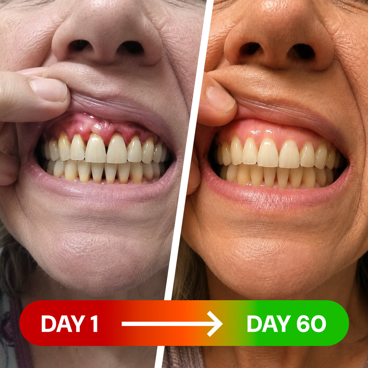 Gum line before and after sixty days